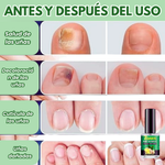 JoyPretty™ el cuidado intensivo de uñas+ envio gratis  L800 (manos y pies)
